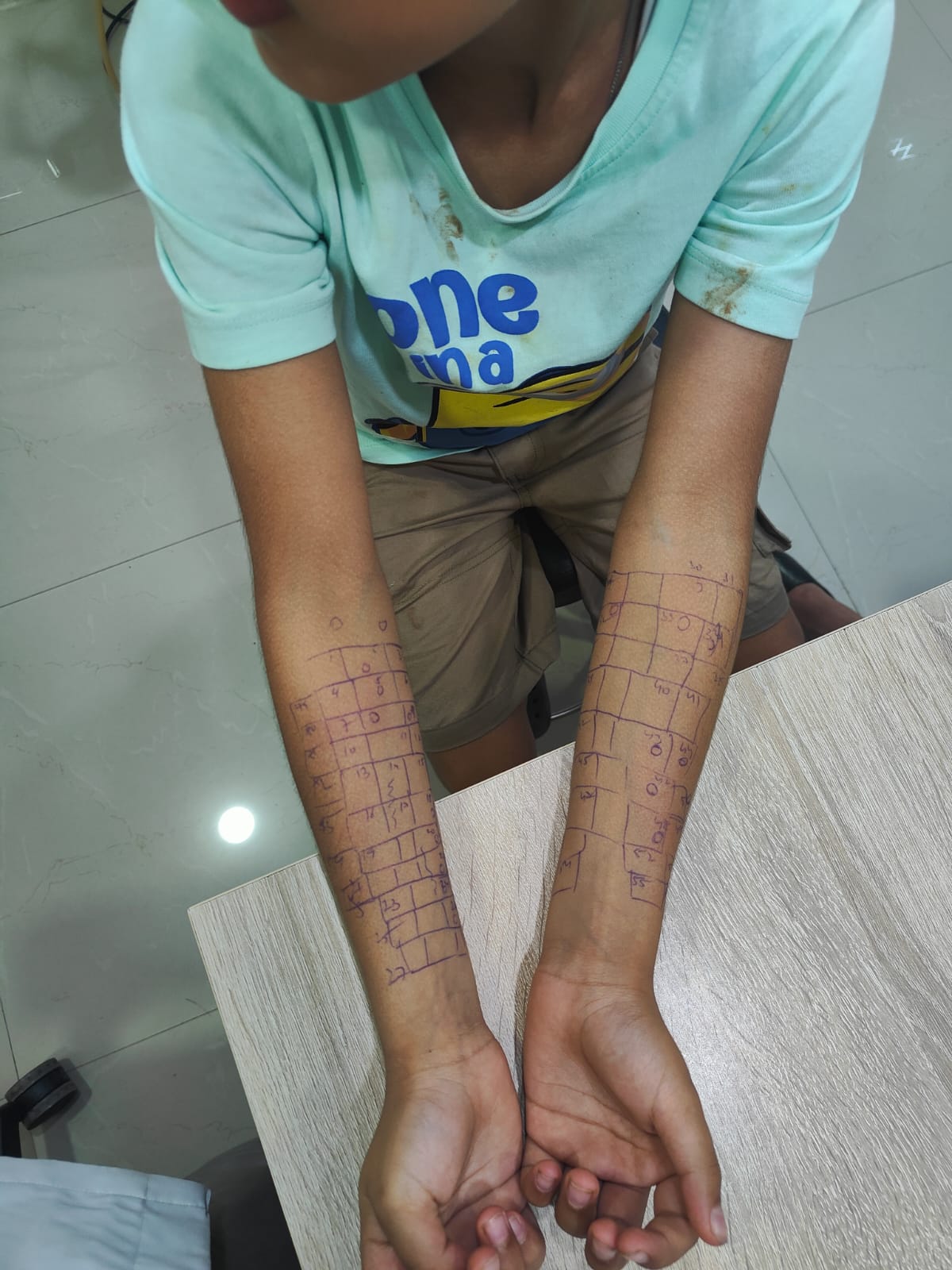 Pediatric allergy skin prick test being performed at ENT Care Clinic